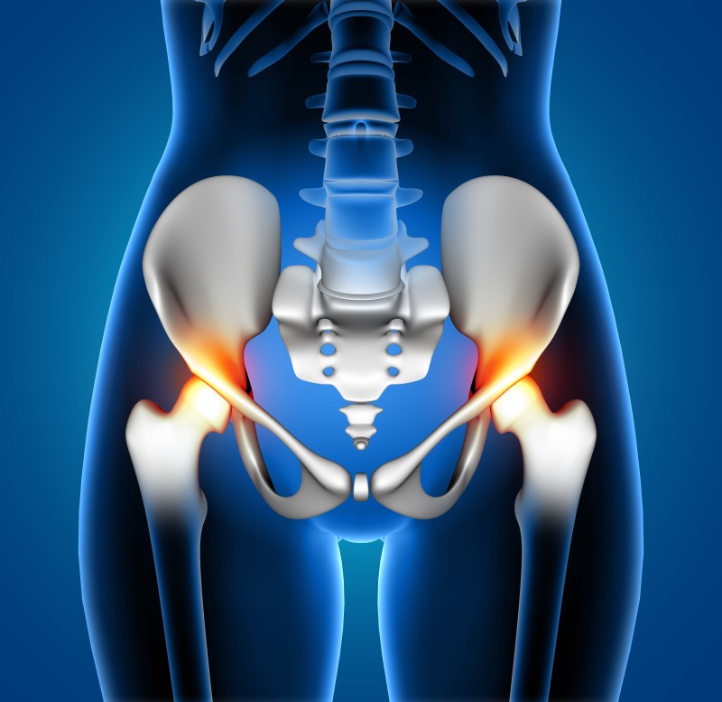 Hip Bursitis